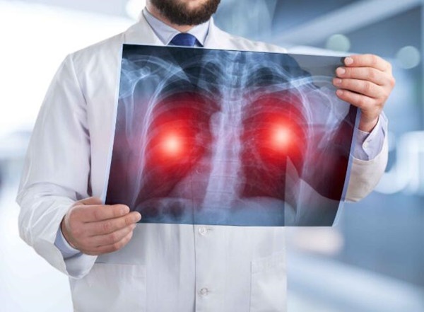 肺癌早期，除了咳嗽，这几个症状虽隐蔽却不难发现，注意观察