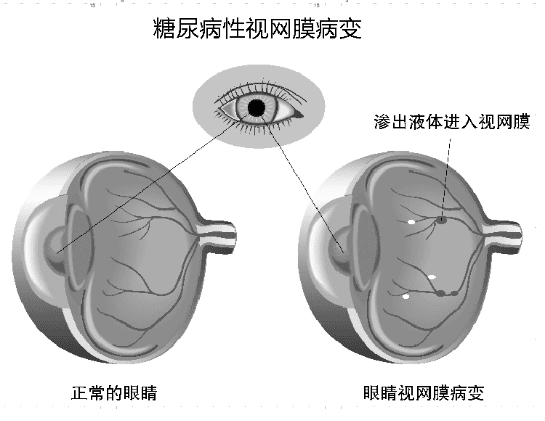 糖友看不清东西？快去查眼底！