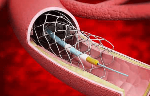 冠脉支架带量集采 在天津开标“大降价”